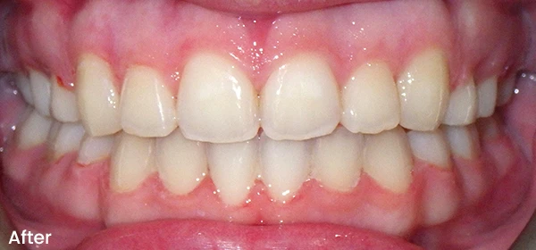 Alexa M After Treatment