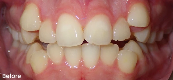 Alexa M Before Treatment
