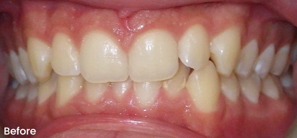 Anthony K Before Treatment