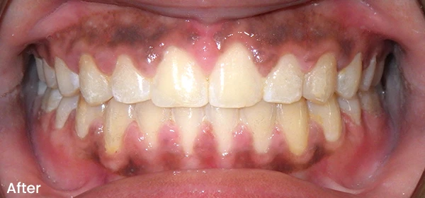 Ayannah B After Treatment