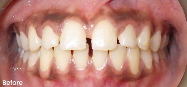 Ayannah B Before Treatment