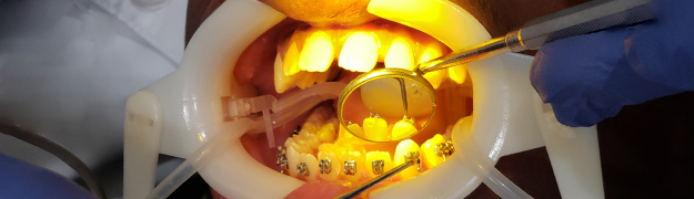 Braces Treatment in Miami Braces Treatment in Miami