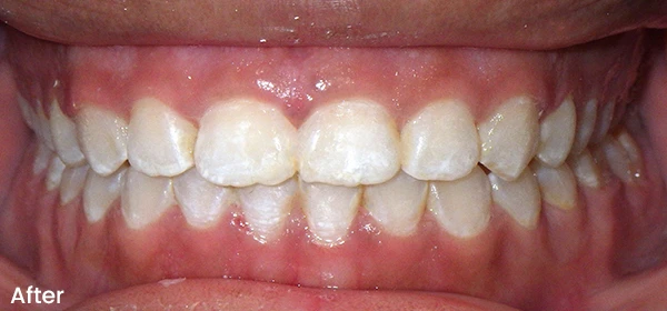 Diane B After Treatment