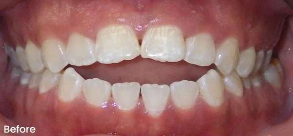 Diane B Before Treatment