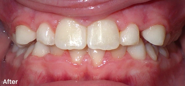 Gabriella R After Treatment
