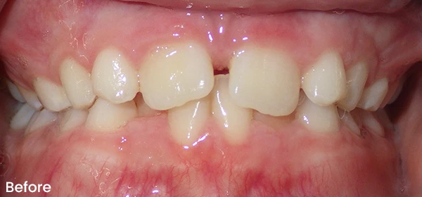 Gabriella R Before Treatment