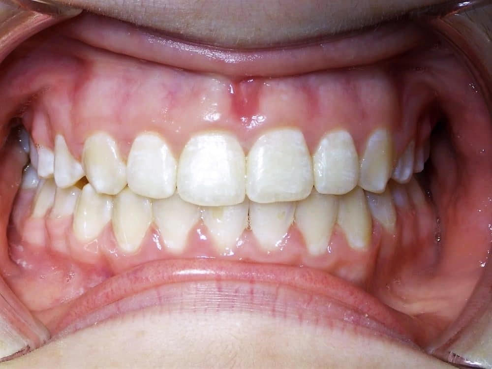 After-patient 6