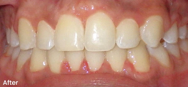 Jason C After Treatment