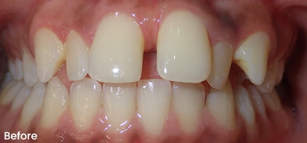 Jason C Before Treatment