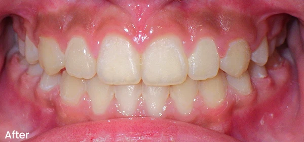 Kayli L After Treatment
