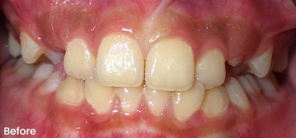 Kayli L Before Treatment