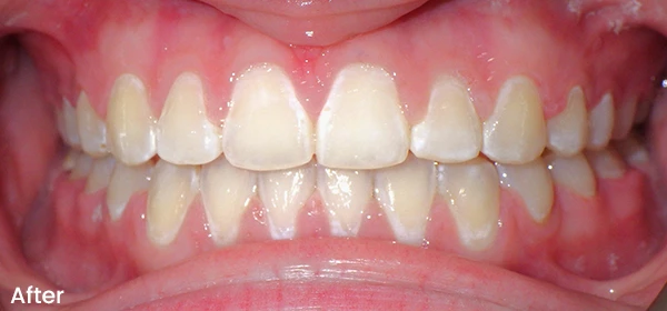 Maive W After Treatment