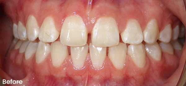 Maive W Before Treatment