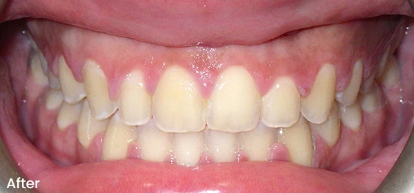 Rosandra D After Treatment