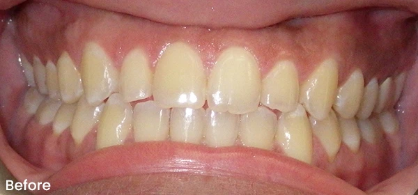Rosandra D Before Treatment