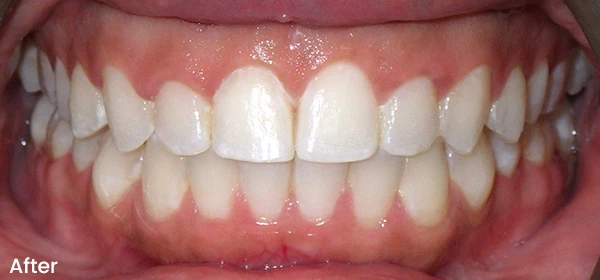 Shamara B After Treatment
