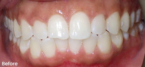 Shamara B Before Treatment