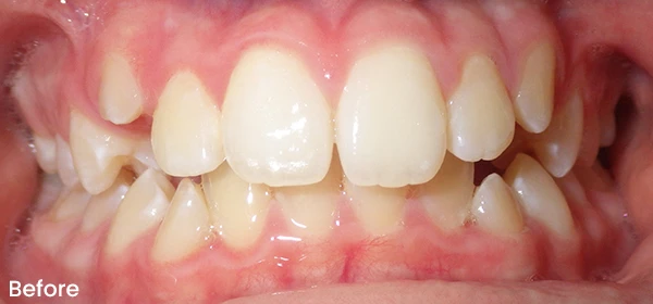 Vincent S Before Treatment