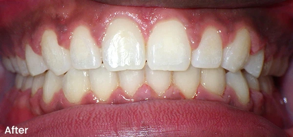Wedcharson D After Treatment