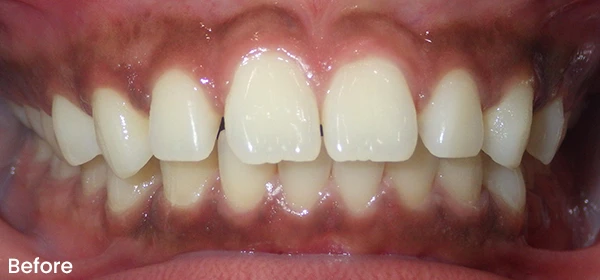Wedcharson D Before Treatment