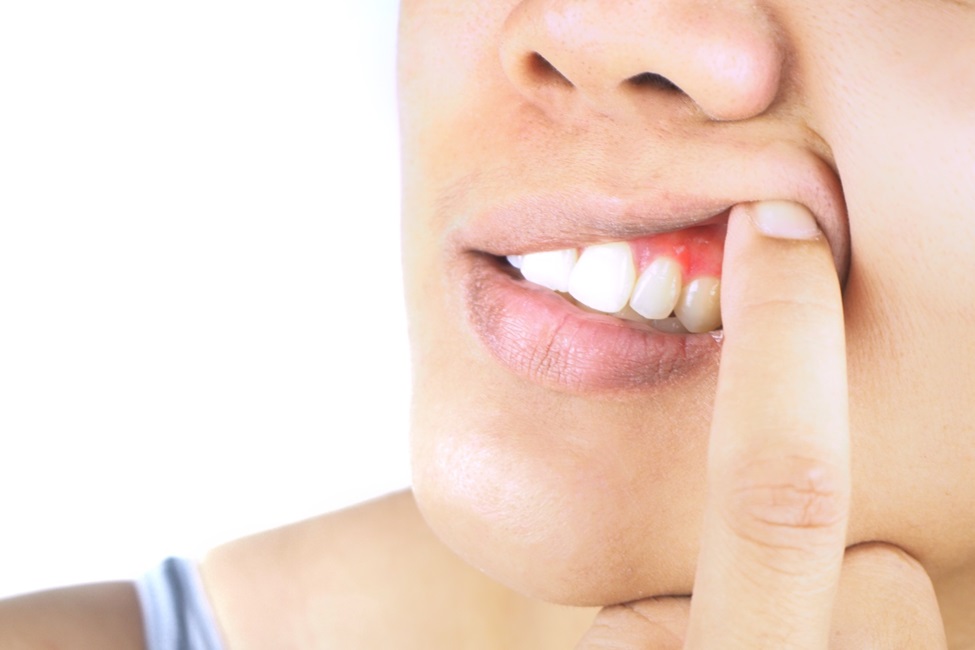 Periodontal Pocket