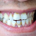 dental calculus