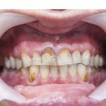 Carious Cavities