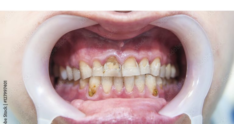 Carious Cavities