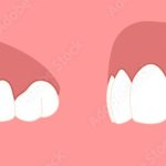 my tooth hurts when I bite down