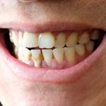 Tooth Calculus