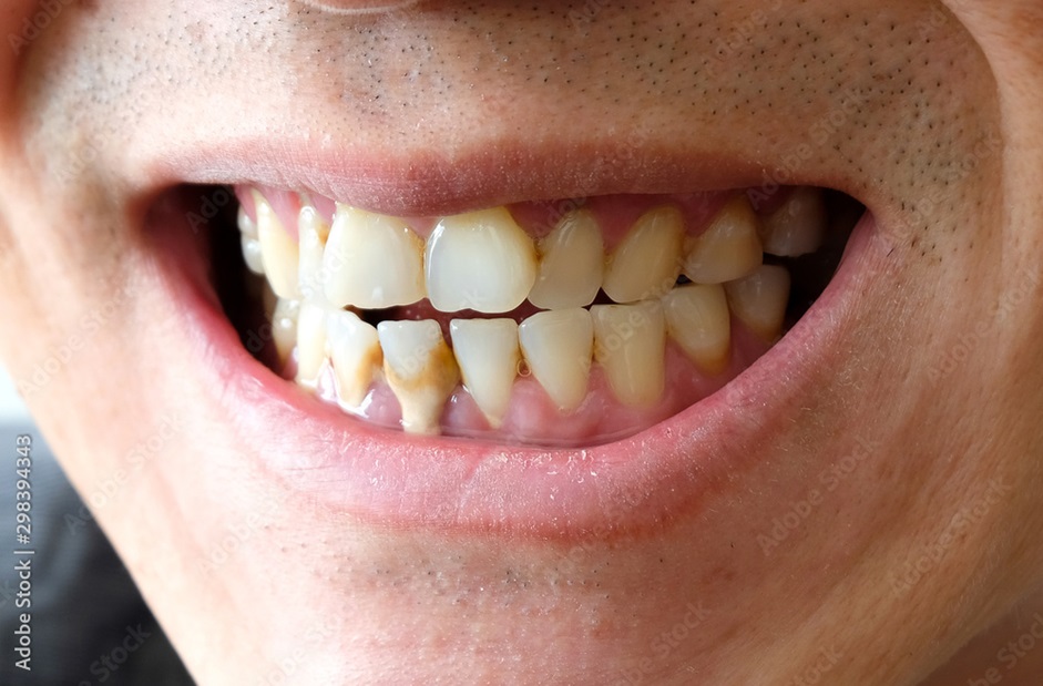 Tooth Calculus