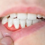Gums Separating From Teeth