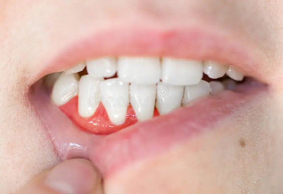 Gums Separating From Teeth