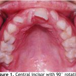 Rotated Tooth
