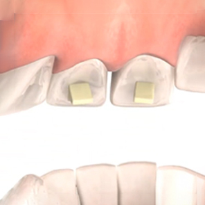 Bite Turbos | How Long Do Turbos Last Braces