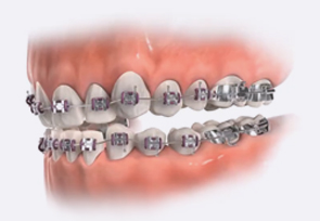 Bite Turbos | How Long Do Turbos Last Braces