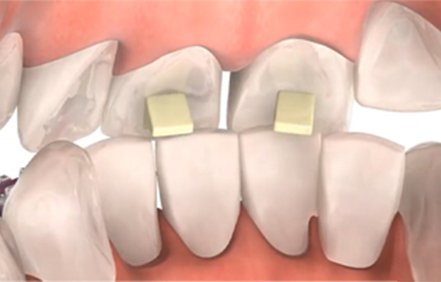 Bite Turbos | How Long Do Turbos Last Braces