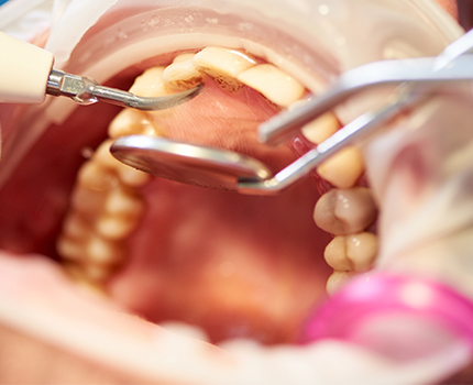 What Should A Tooth Extraction Look Like When Healing What Should A Tooth Extraction Look Like When Healing