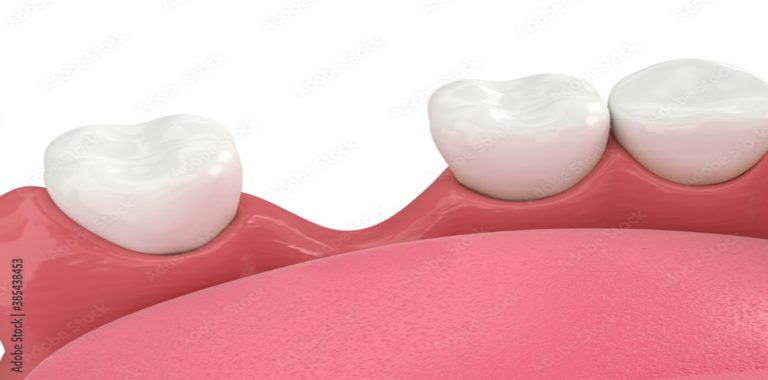 Bone Loss in Teeth