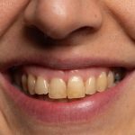 Yellow Stain OnTeeth