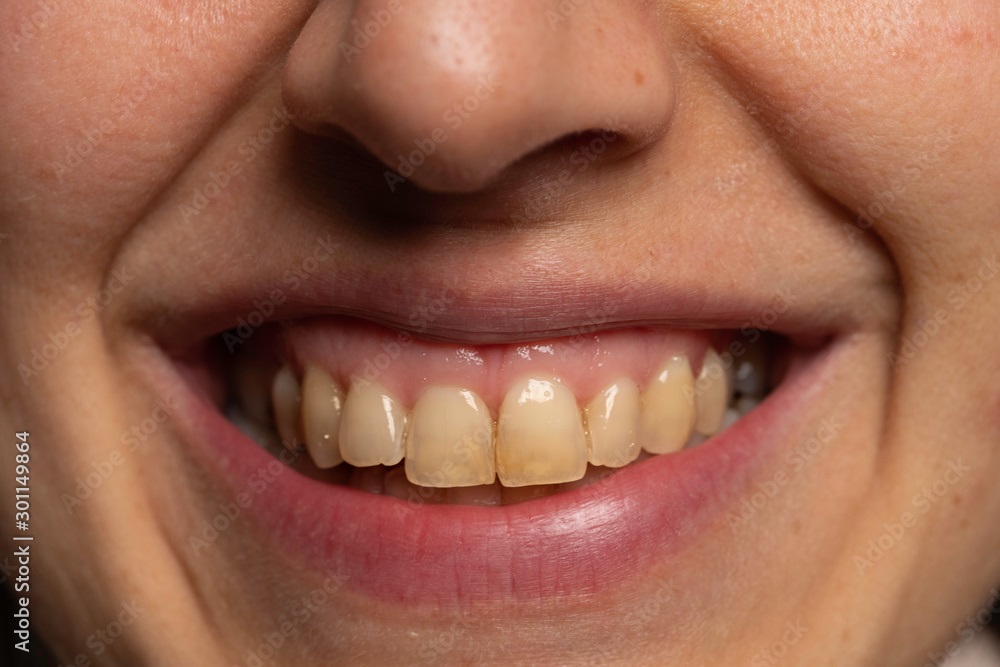 Yellow Stain OnTeeth