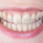 Tooth Demineralization