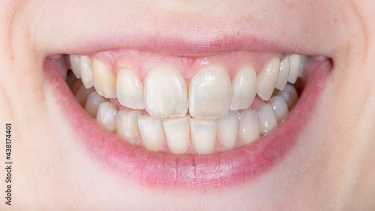 Tooth Demineralization