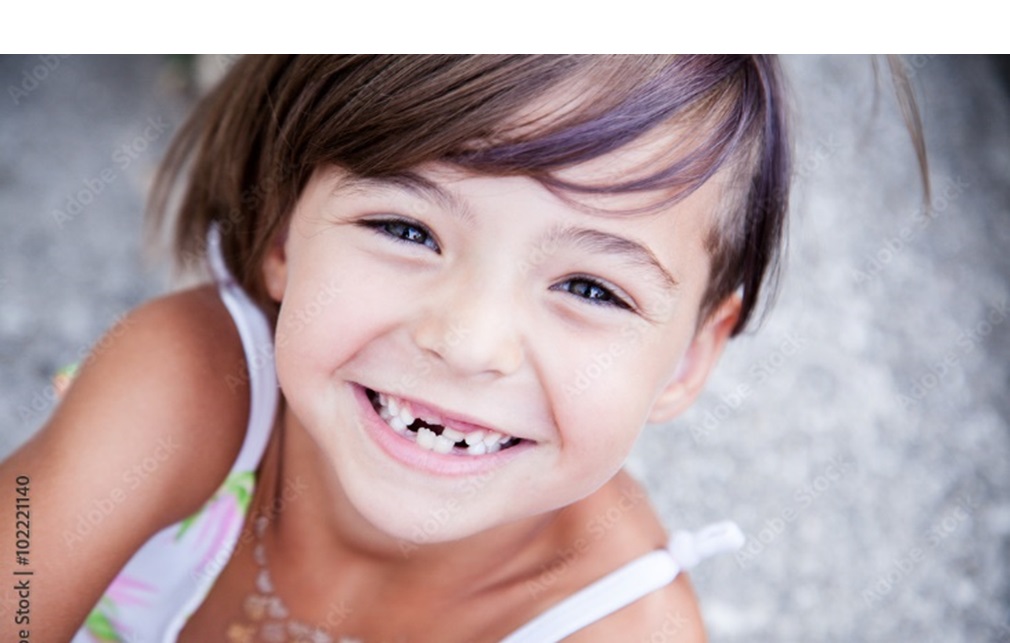 mamelons on teeth 