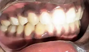 After Overbite Braces After Overbite Braces