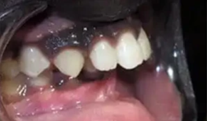 Before Overbite Braces Before Overbite Braces