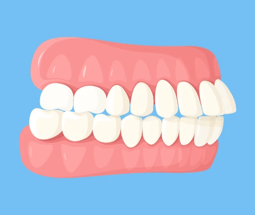 Correct An Overbite Correct An Overbite