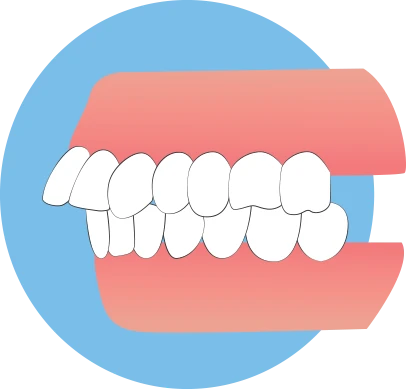 Living With An Overbite Living With An Overbite