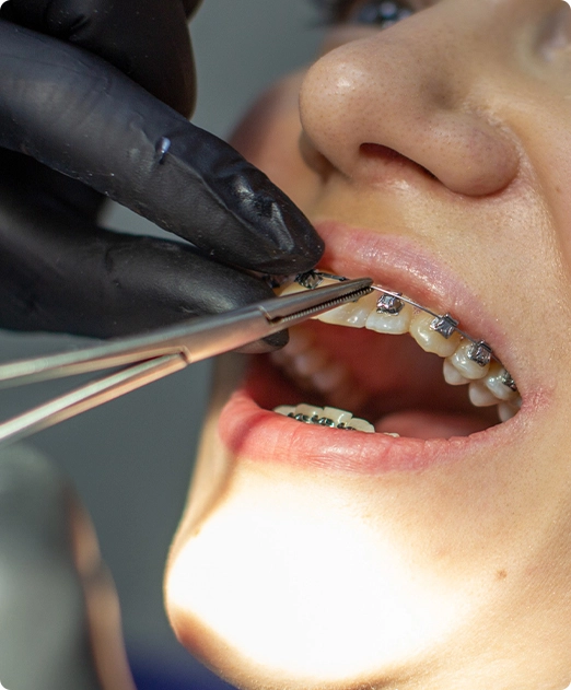 metalbraces