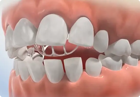 tonguecribdo braces miramar